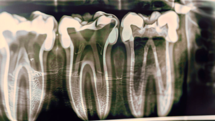 Radiographie dentaire étalonné